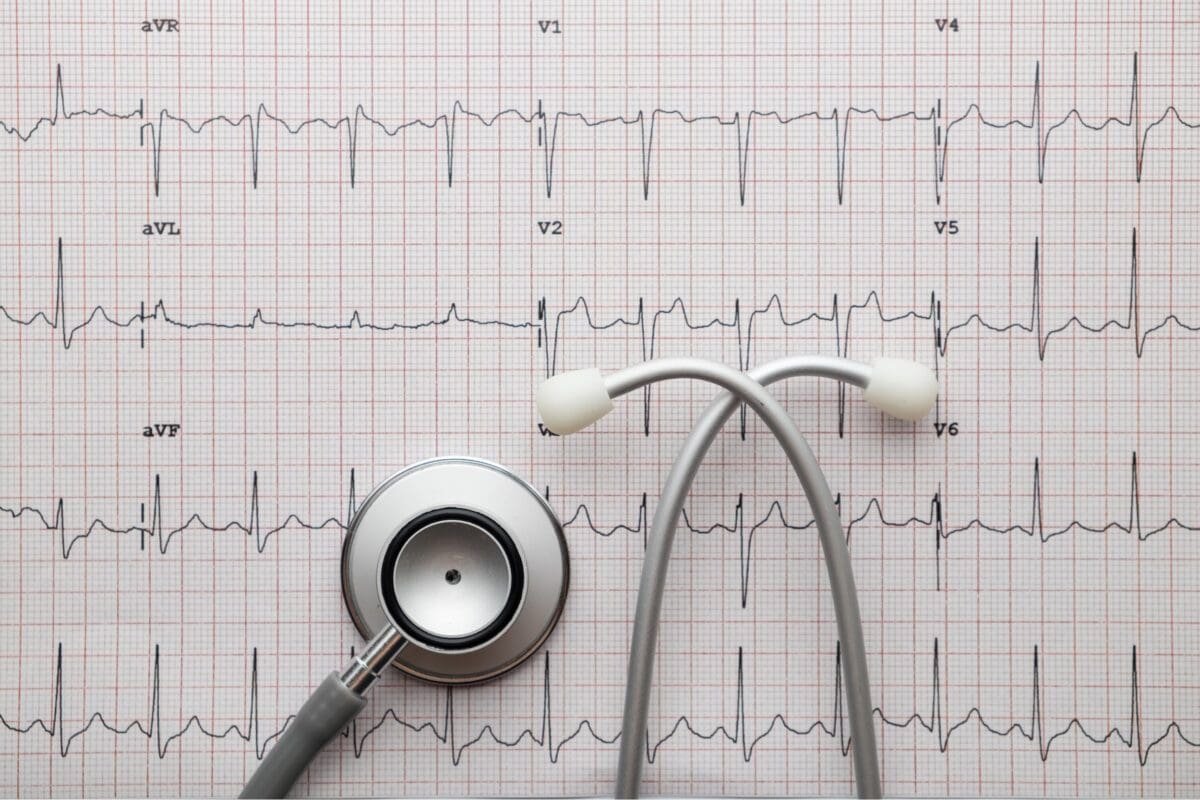Electrocardiogram